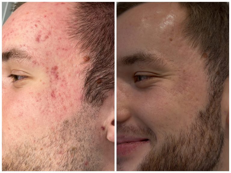 Комплексное лечение акне