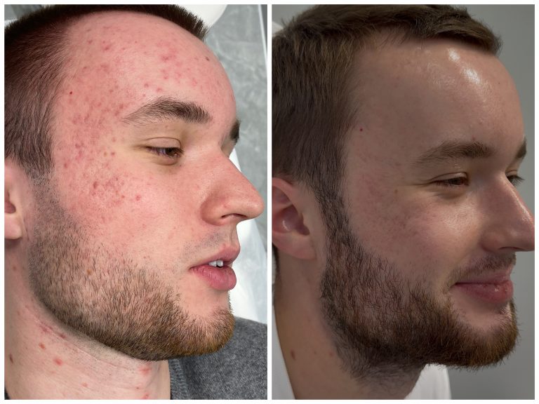 Комплексное лечение акне