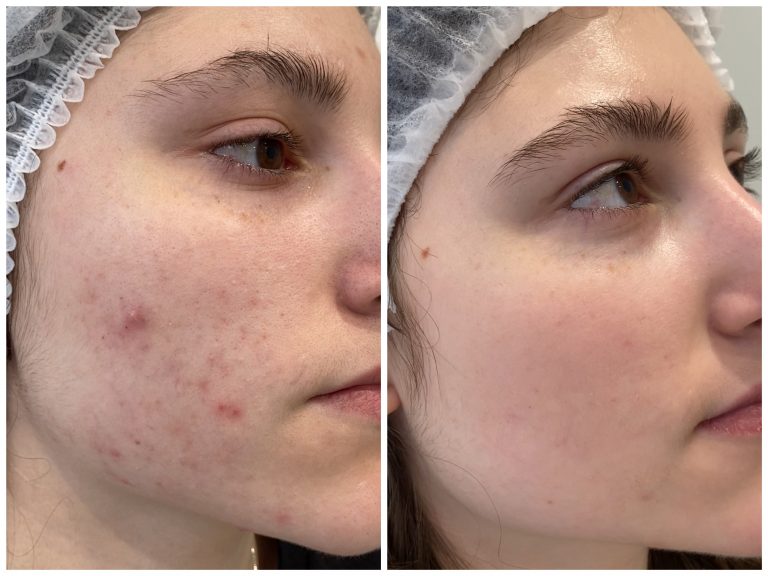 Комплексное лечение акне