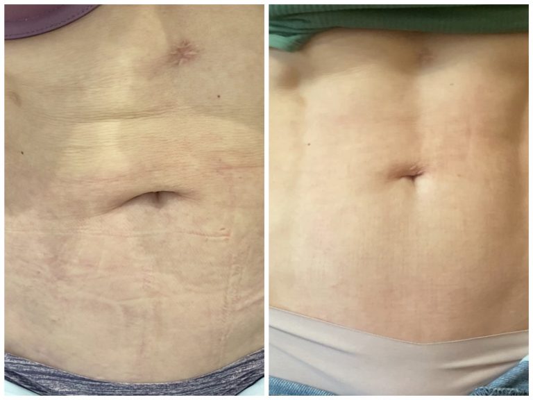 Игольчатый RF-лифтинг + Коллагеностимуляция