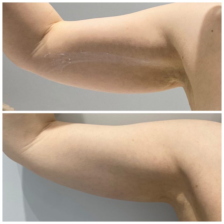 Эндолифтинг (безоперационная подтяжка) внутренней части плеча