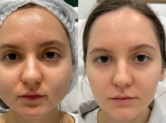 КОМПЛЕКСНЫЙ ЛИФТИНГ И УМЕНЬШЕНИЕ ОБЪЁМОВ ЛИЦАИНЪЕКЦИОННЫМИ И АППАРАТНЫМИ МЕТОДАМИ