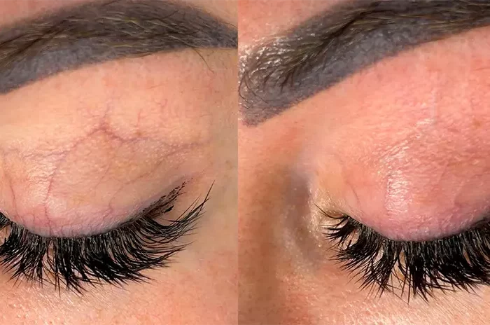 ЛАЗЕРНОЕ УДАЛЕНИЕ СОСУДОВ В ОБЛАСТИ ВЕК