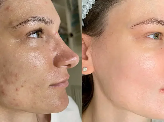 КОМПЛЕКСНОЕ ЛЕЧЕНИЕ ПИГМЕНТАЦИИ И АКНЕ