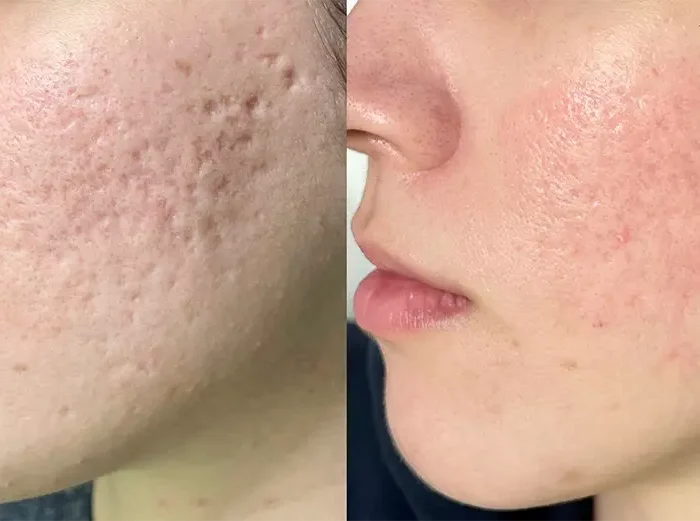 ЛАЗЕРНАЯ КОРРЕКЦИЯ РУБЦОВ ПОСТАКНЕ