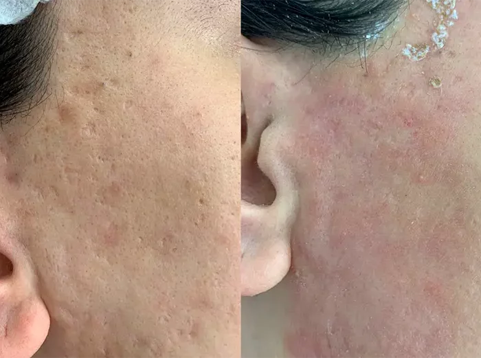 ЛАЗЕРНАЯ КОРРЕКЦИЯ РУБЦОВ ПОСТАКНЕ