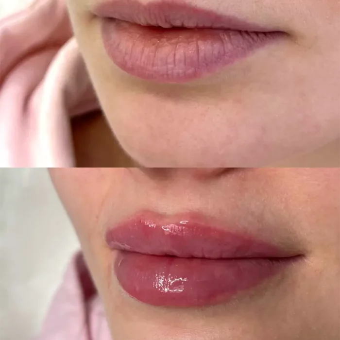 КОНТУРНАЯ ПЛАСТИКА ГУБ