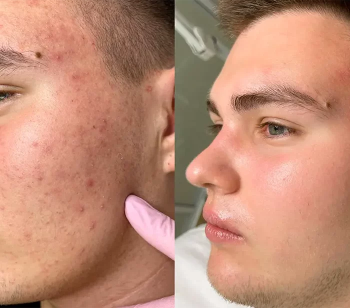 КОМПЛЕКСНОЕ ЛЕЧЕНИЕ АКНЕ