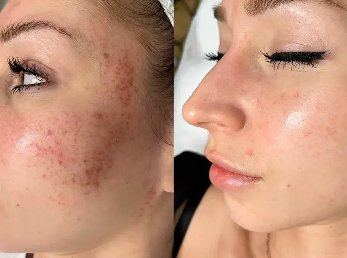 КОМПЛЕКСНОЕ ЛЕЧЕНИЕ РОЗАЦЕА