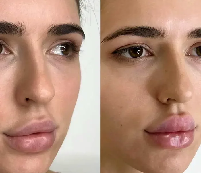 КОНТУРНАЯ ПЛАСТИКА ВЕРХНЕЙ ТРЕТИ
ПРЕПАРАТОМ RADIESSE