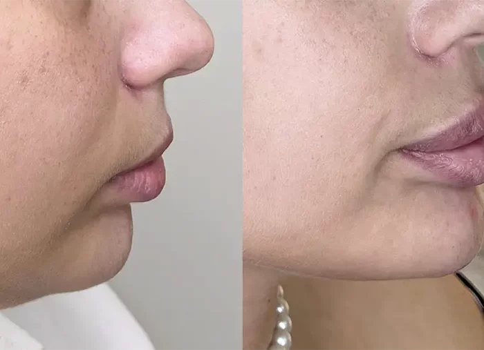 ИНЪЕКЦИОННЫЙ ЛИФТИНГ ОВАЛА ЛИЦА