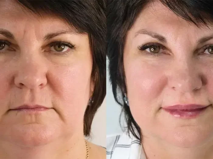 БОТУЛИНОТЕРАПИЯ И КОНТУРНАЯ ПЛАСТИКА ГУБ