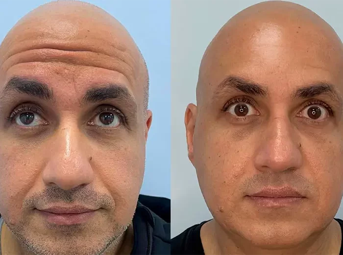 КОРРЕКЦИЯ МОРЩИН С ПОМОЩЬЮ БОТУЛИНОТЕРАПИИ