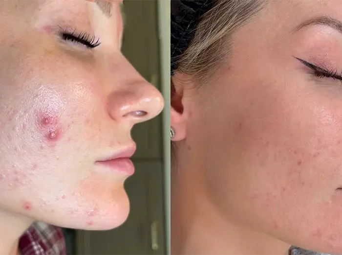 КОМПЛЕКСНОЕ ЛЕЧЕНИЕ АКНЕ