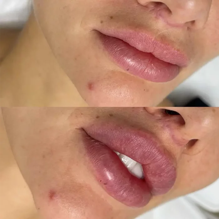 КОНТУРНАЯ ПЛАСТИКА ГУБ