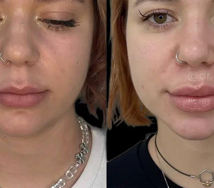 АППАРАТНЫЙ ЛИФТИНГ