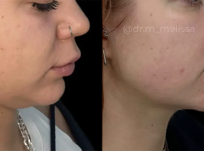 АППАРАТНЫЙ ЛИФТИНГ