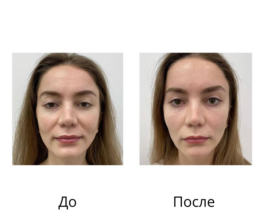 Альтера-терапия