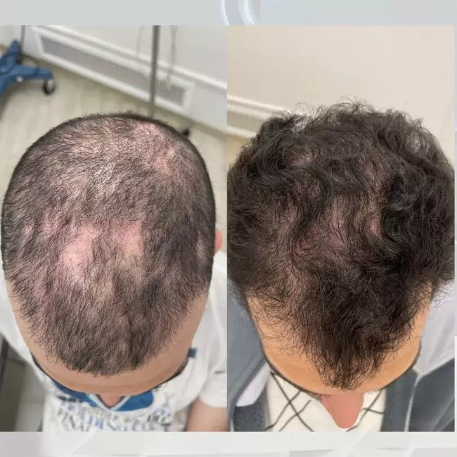 Тромбоцитарно-лейкоцитарная аутоплазма