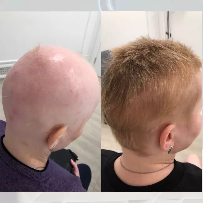 Комплексное лечение волосистой части головы