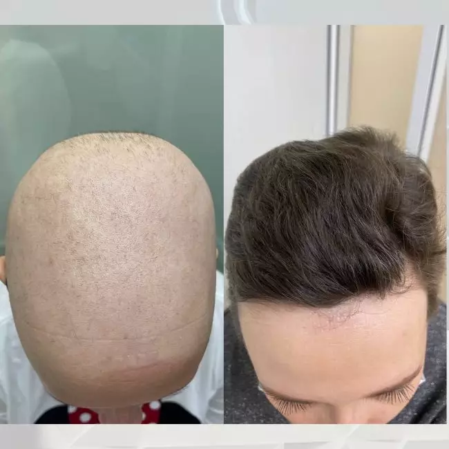 Комплексное лечение волосистой части головы