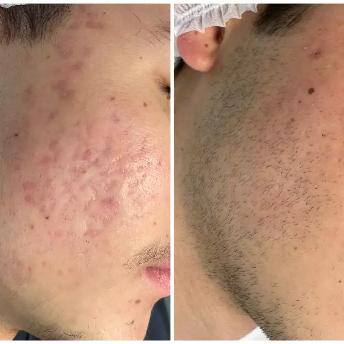 РФ-лифтинг Sylfirm