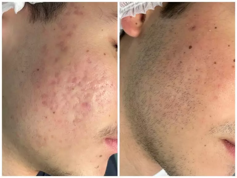 РФ-лифтинг Sylfirm