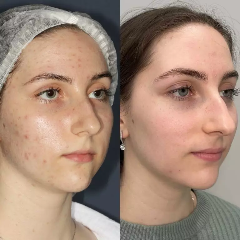 Комплексное лечение акне