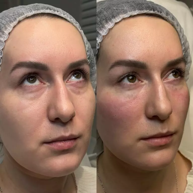 Коррекция носослезной борозды