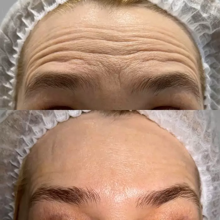 Ботулинотерапия морщин лба