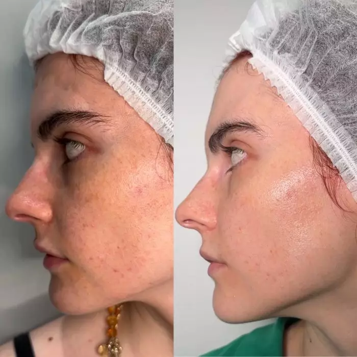 Комплексное лечение акне