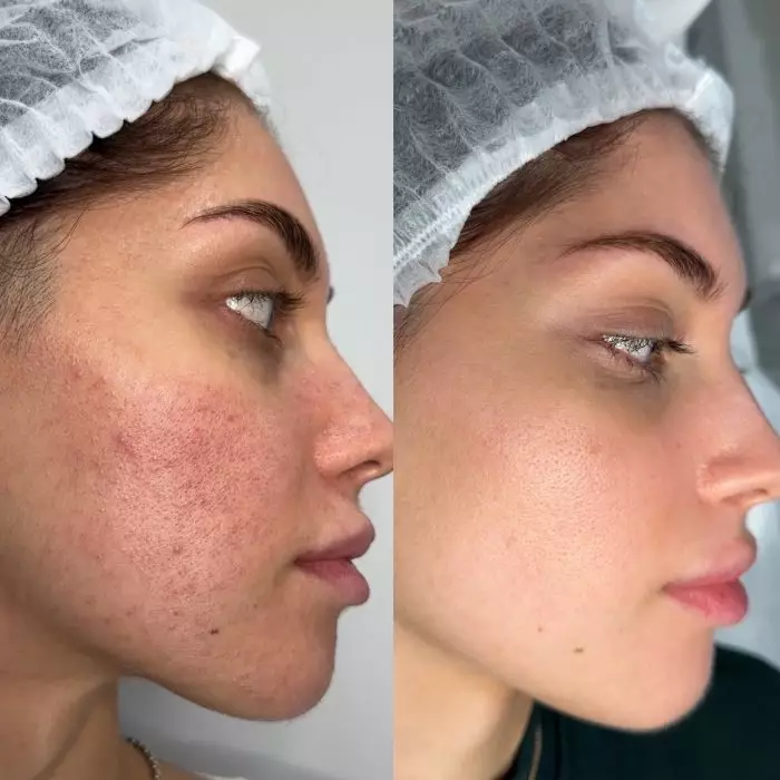 Комплексное лечение акне