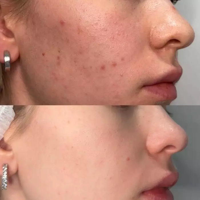 Комплексное лечение акне