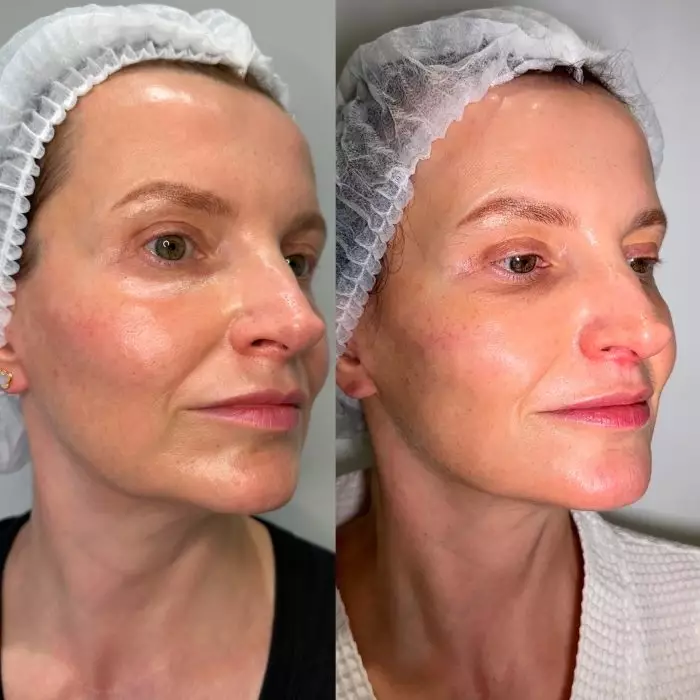 Безоперационный аппаратный SMAS-лифтинг овала лица