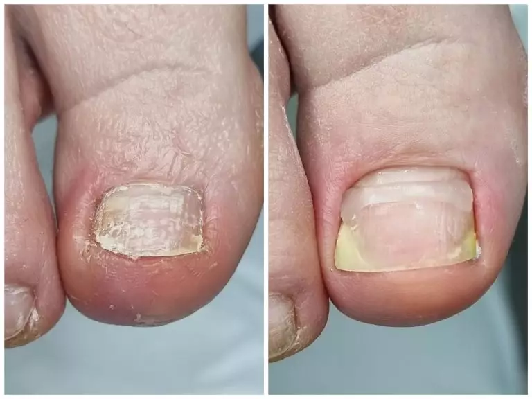 Коррекция роста вросшего ногтя