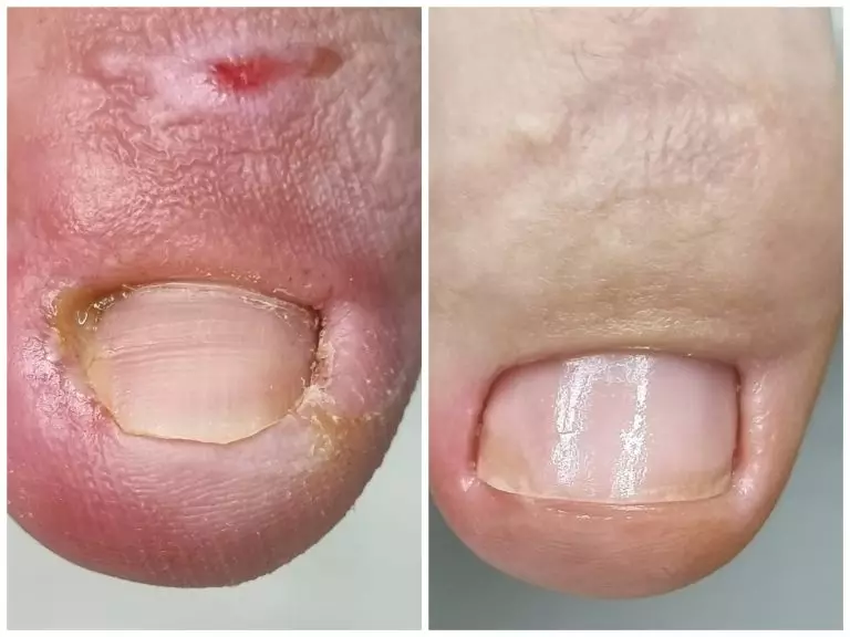 Лечение онихокриптоза или вросший ноготь