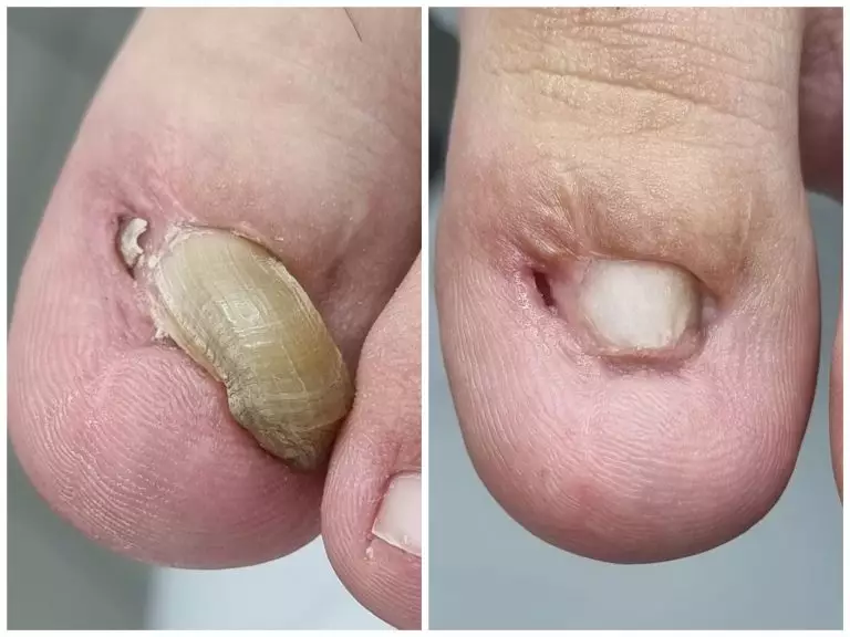 Онихогрифоз или деформация ногтя в следствии травмы