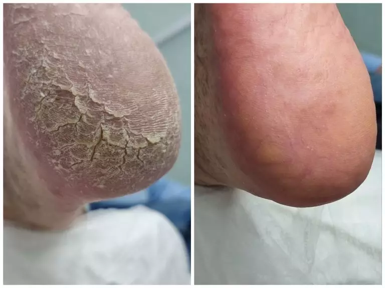 Дерматомикоз или грибковое заболевание кожи стоп