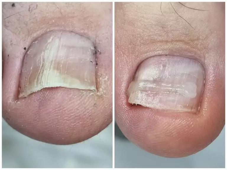 Коррекция роста деформированных ногтевых пластин