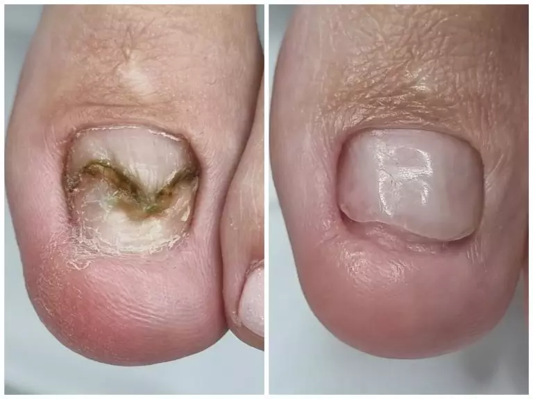 Восстановление роста ногтевой пластины после травмы