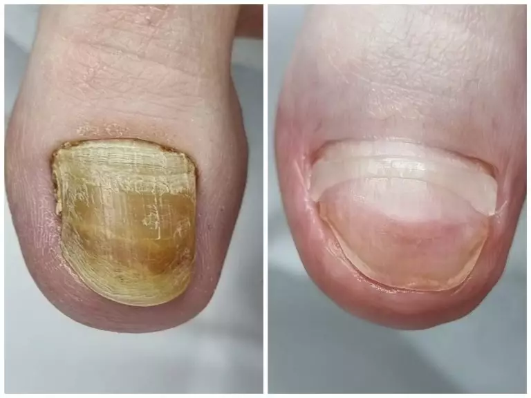 Дистрофия ногтевой пластины. Восстановление после оперативного лечения