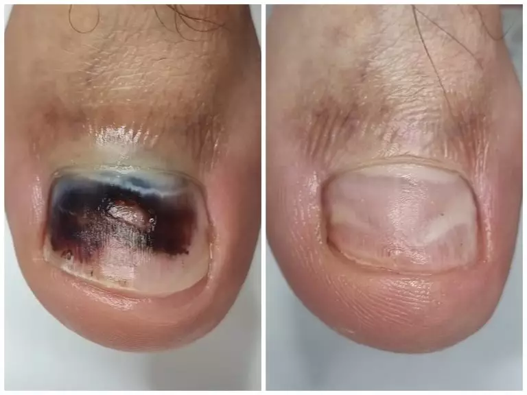 Травмы ногтей