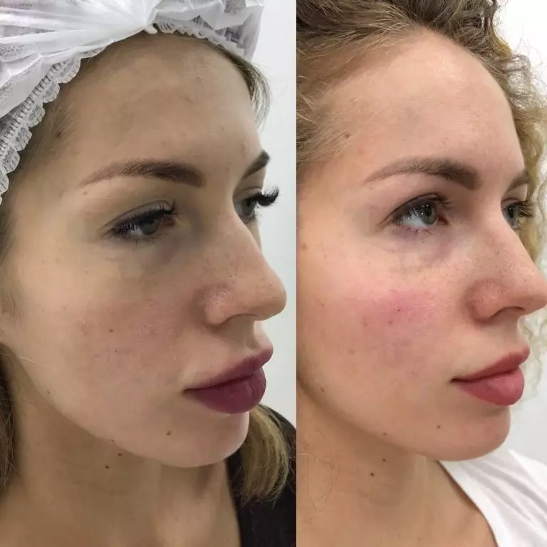 Коррекция скул