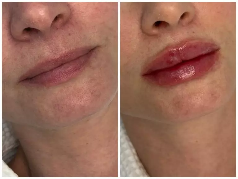 Контурная пластика губ, врач Луковкина А.А.