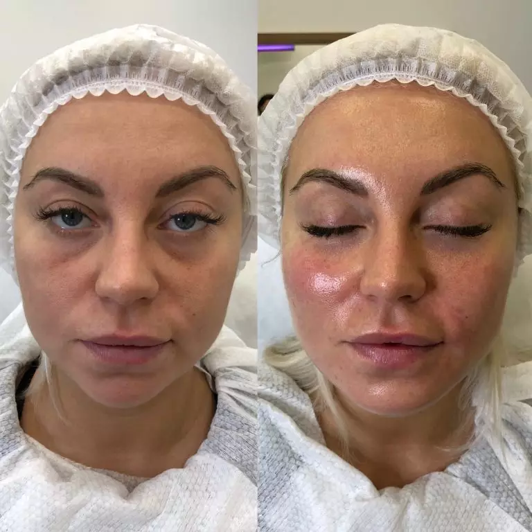 Контурная пластика/гармонизация лица