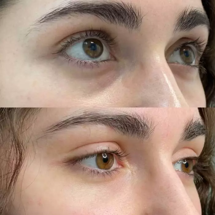 Коррекция носослезной борозды