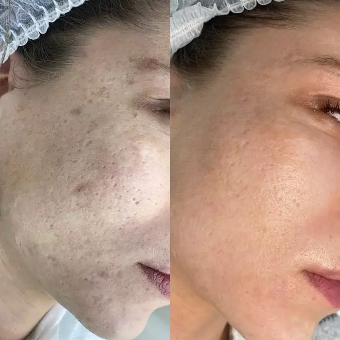 Фракционный фототермолиз (лазерная шлифовка)