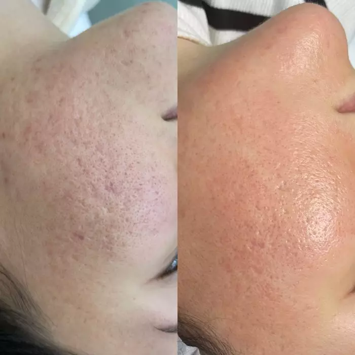 Фракционный фототермолиз (лазерная шлифовка)