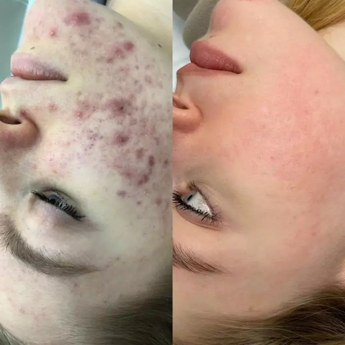 Комплексное лечение акне