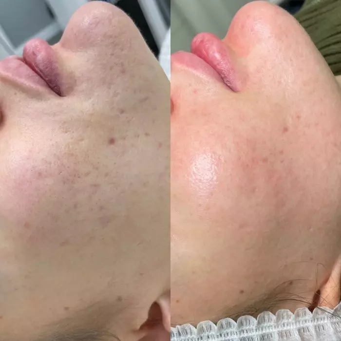 Фракционный фототермолиз (Лазерная шлифовка) Halo